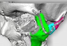 Хирурги будут реконструировать лицо, используя технологию 3D-печати 3D-печать