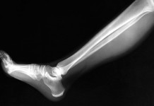 Имплантируемый био-патч позволяет восстанавливать кости био-патч