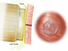 Медицинский супер клей