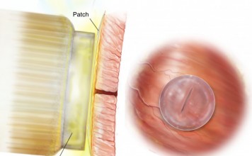 Медицинский супер клей