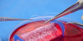 синдром Mayer-Rokitansky-Küster-Hauser