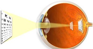 Астигматизм