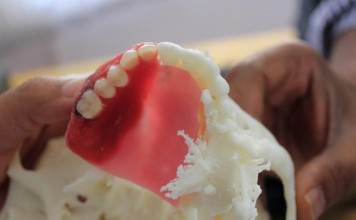 3D-печать помогает создавать верхнюю челюсть для больного раком челюсть 3D