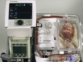heart transplant