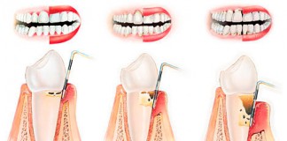 Здоровье зубов