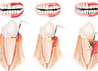 Здоровье зубов