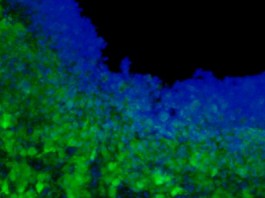 Производящие токсин стволовые клетки борются с опухолями головного мозга toxic stem cell