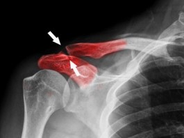 Магнитные наночастицы могли бы помочь излечить переломы костей collarbone