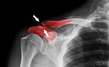 collarbone