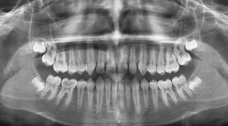 panoramnyj-snimok-zubov-foto