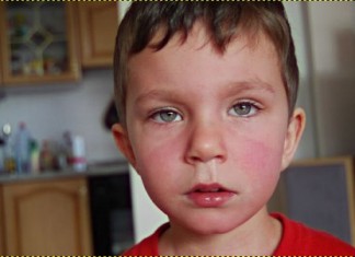 Краснота на лице не навсегда