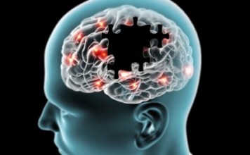 alzheimers