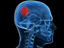 Ученые определяют новый механизм лечения рака головного мозга shutterstock