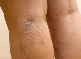 Лечение тромбоза глубоких вен