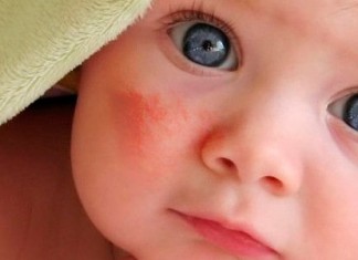 Диатез лечится быстро!