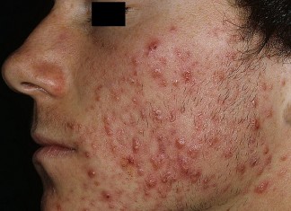 Акне — это не приговор!