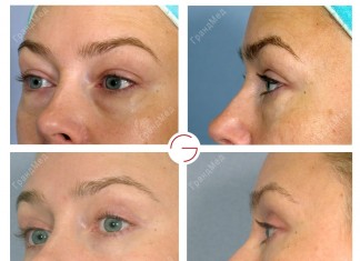 Блефаропластика у нас