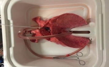 Новый метод служит хорошим предзнаменованием повышения успешности пересадки легкого