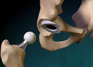 Замена сустава в тазу