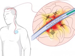 Создан имплант способный поставить на ноги парализованных Создан имплант способный поставить на ноги парализованных