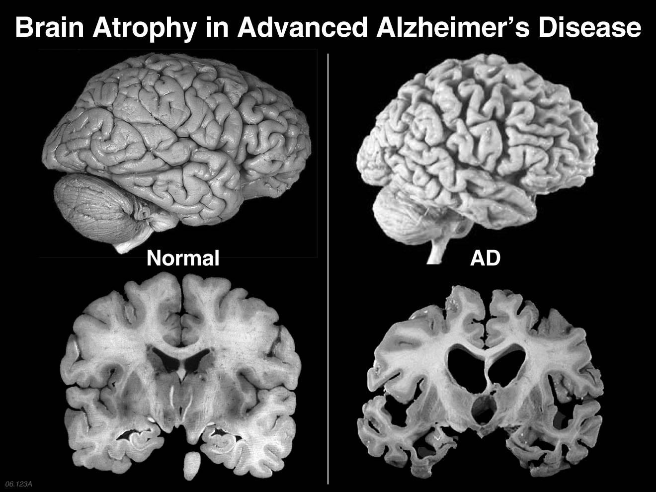 Alzheimers-Disease