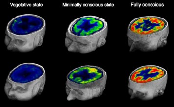 Ученые предлагают определять степень комы по глюкозе