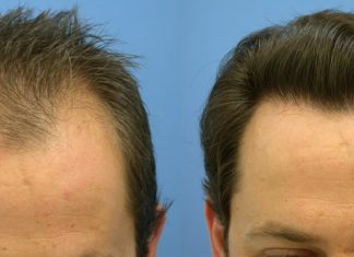 Пересадка волос лучшим образом!