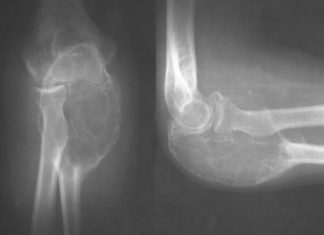 Избавление от гиперостоза китайскими средствами Гиперостоз