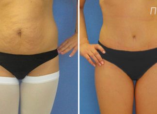 Пластика живота