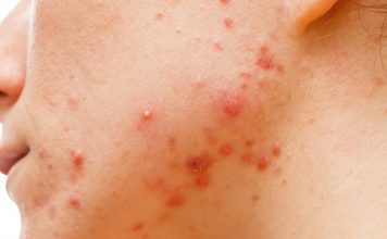 Ученые выяснили откуда берется акне