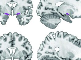 Синдром Альцгеймера