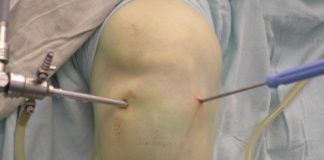 Артроскопия