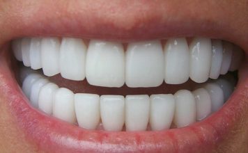 Лазерная имплантация зубов: преимущества технологии Зубы