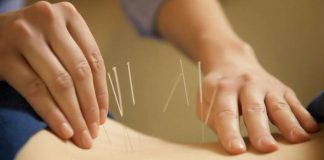 Акупунктура