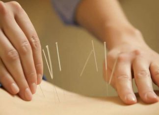 Акупунктура