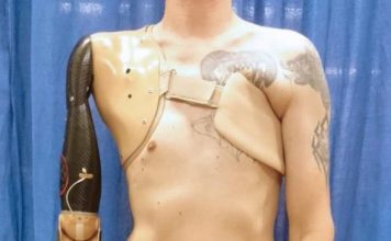 Разработан неинвазивный метод биопротезирования