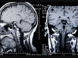 Ученые научились определять биологический возраст по мозгу