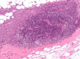 Обнаружен биомаркер, запускающий «агрессивный» рак груди