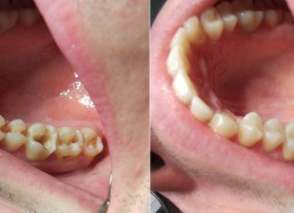 Для чего нужны временные пломбы на детские зубы? Пломба