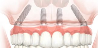 Имплантация