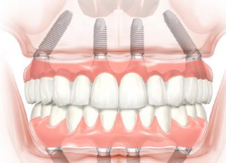 Имплантация