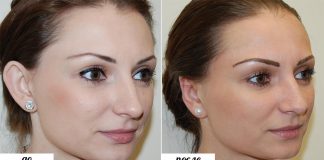 Коррекция ушей