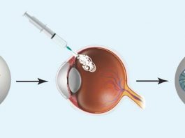 В Университете Южной Калифорнии разрабатывается клей для глаза