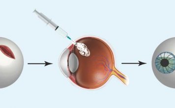 В Университете Южной Калифорнии разрабатывается клей для глаза