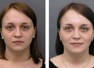 Ринопластика в Киеве — что выбирать? Ринопластика