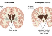 Найден потенциальный способ победить болезнь Хантингтона