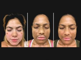 Доктора разработали метод лечения витилиго