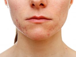 Калифорнийские специалисты готовят вакцину против акне