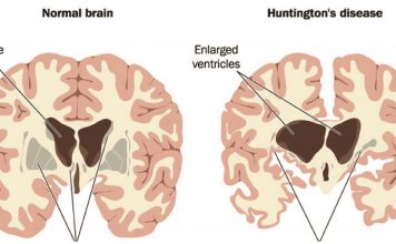 Раскрыта новая деталь процесса гибели нейронов в головном мозге