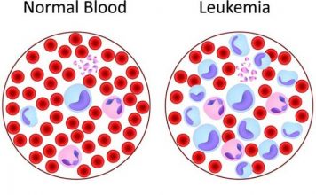 Исследуется возможность борьбы с лейкемией посредством блокировки гена MLL